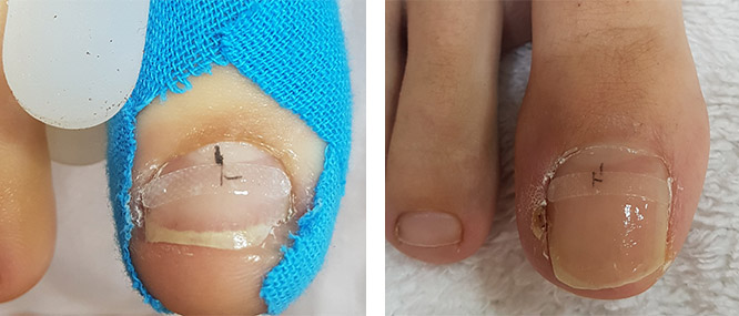 Batık Tırnak BS Bant Sistemi Uygulamasının Etkileri