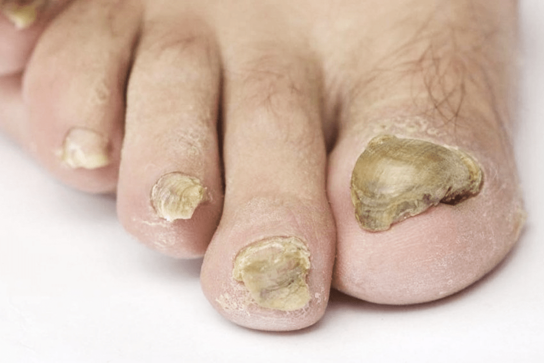 Tırnak Mantarı (Mantarlı Tırnak Bakımı Uygulamaları)