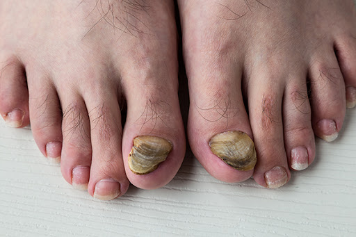 Kalınlaşmış Tırnak Bakımı