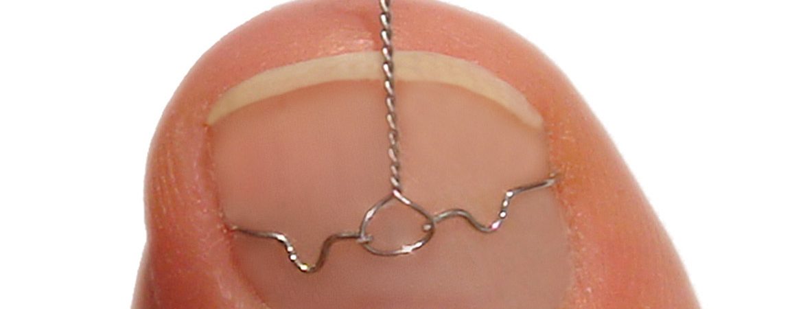 Batık Tırnakta 3TO Tel Sistemi Uygulaması