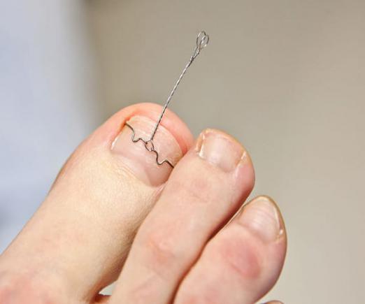 Tırnak Batması Bakımı ve Ara Tel Uygulaması