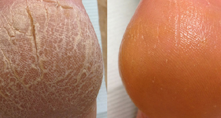 Çatlak Topuk Bakımı